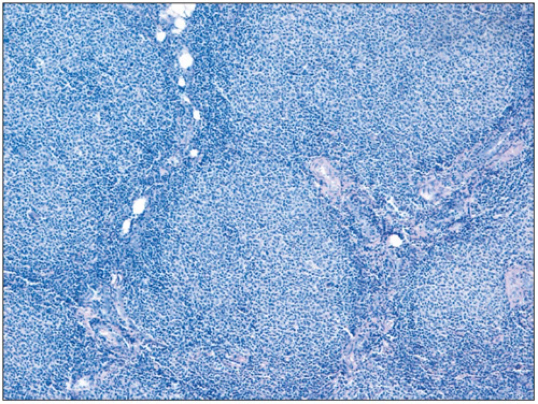 Obraz patologických folikulů folikulárního lymfomu (barvení hematoxylin-eosin; zvětšení 100x).