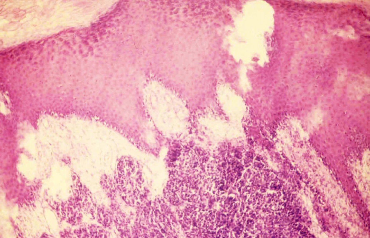 Nehtová ploténka a hřebeny nehtového lůžka, v dolní části korium s infiltrací akrolentiginózním melanomem. Hematoxylin-eozin, zvětšení l00x
Fig. 3. The nail plate with ridges of the nail bed, corium infilatrated with acrolentiginous melanoma, at the bottom. Hematoxylin- eosin, enlargement 100x