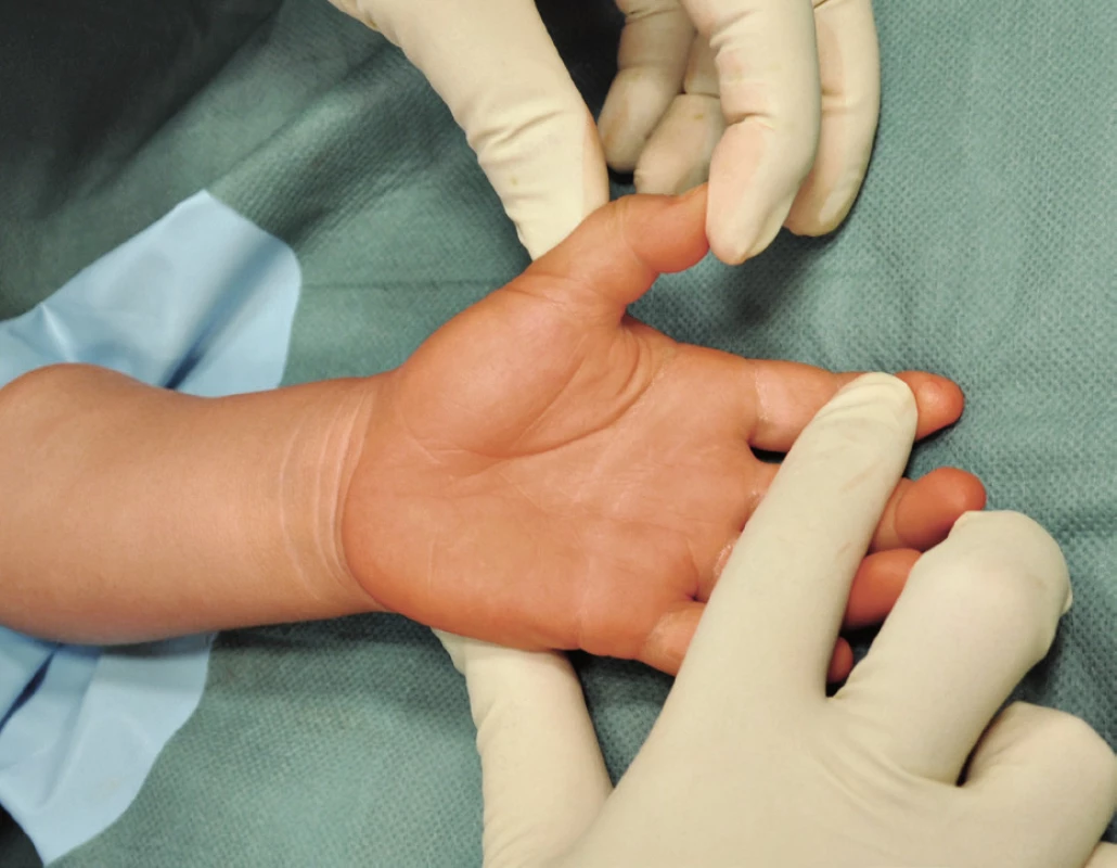 Předoperační vyšetření – palec v semiflexi interfalangeálního kloubu
