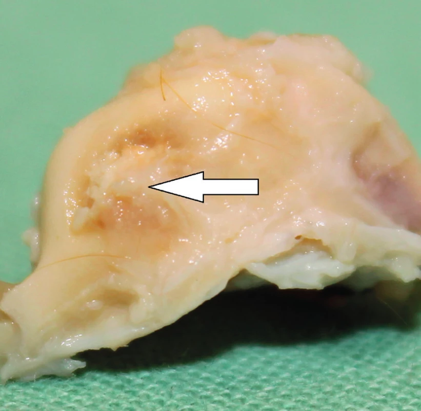 Levá spánková kost morčete 30 dní po implantaci MSC. Šipka ukazuje zhojení kostního defektu v místě implantace biomateriálu.