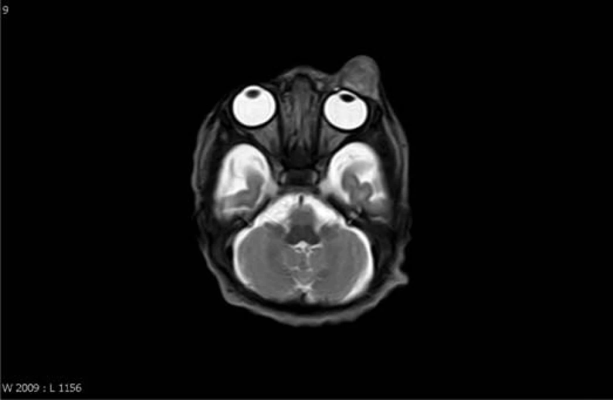 MR mozku – 2. den po narození, velikost útvaru 10 x 4 x 6 mm.