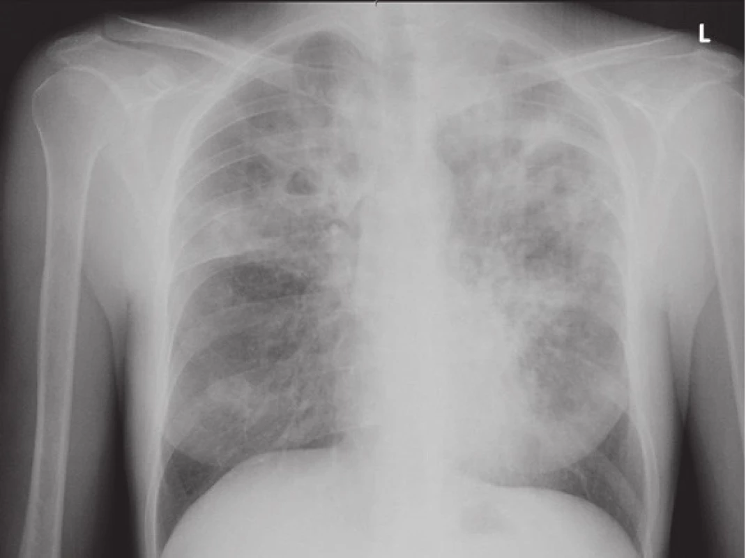 RTG snímek plic matky při přijetí na infekční oddělení.
Fig. 1. Chest X-ray of mother on admission.