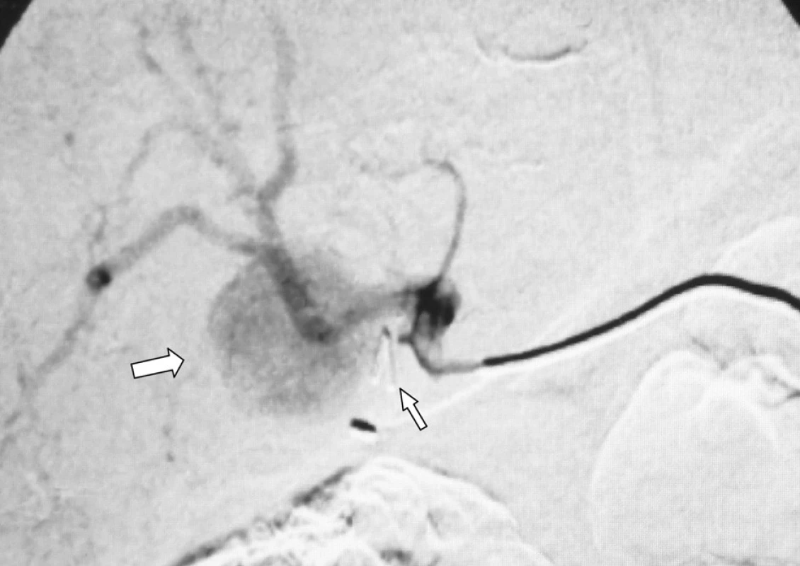 Angiografie truncus coeliacus: aneurysma pravé větve a. hepatica (silnější šipka vlevo) a klip nasazený při laparoskopické cholecystektomii (slabší šipka vpravo)
Fig. 3. Angiography of the truncus coeliacus: an aneurysm of the right hepatic artery (a bold arrow on the left) and a clip applied during the laparoscopic cholecystectomic procedure (a thinner arrow on the left)