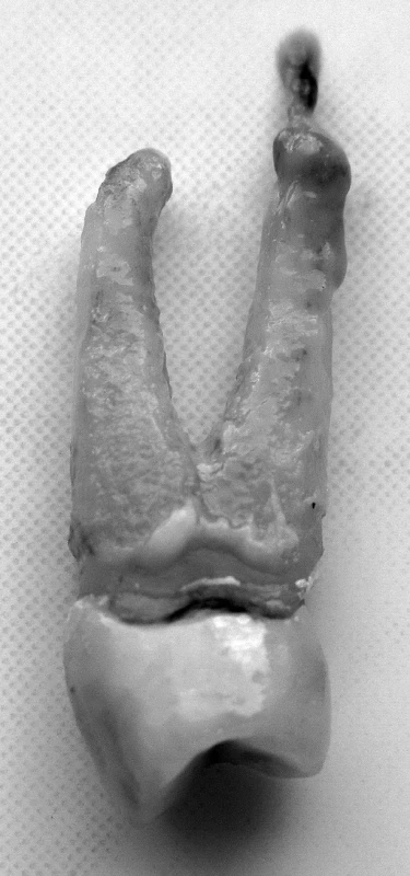 Chronická apikálna parodontitída – periapikálny granulóm (zub 24) – autor Ján Kováč
Fig. 1. Chronic apical periodontitis – periapical granuloma (tooth 24) – Author Ján Kováč