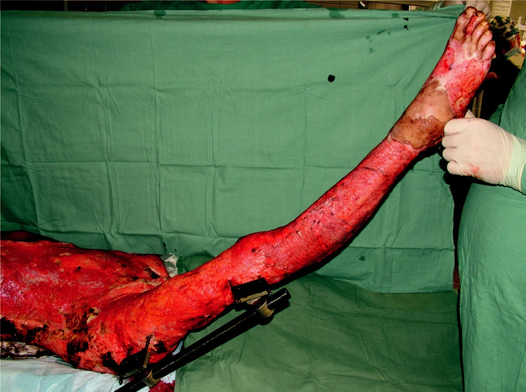 Area of trunk and right lower extremity prepared for autotransplantation (on the right lower crus the first grafts already healed)