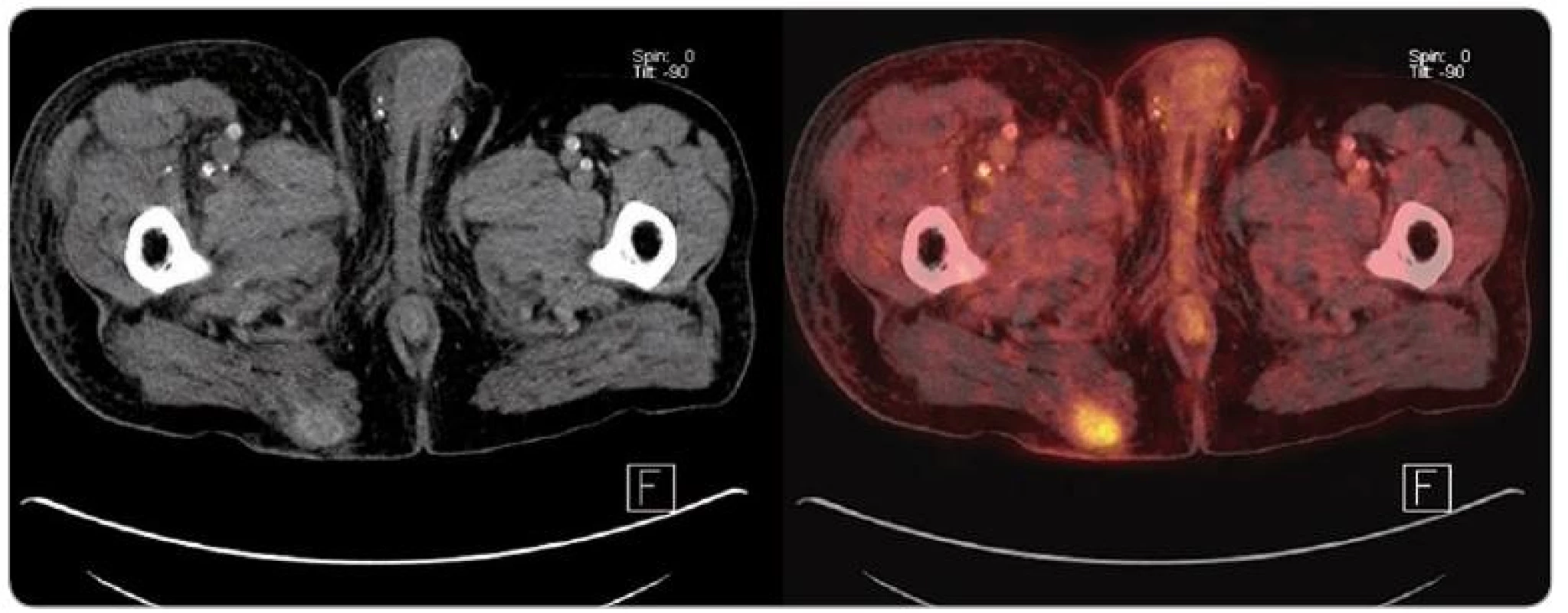 PET/ CT obraz rekurujícího ložiska karcinomu z Merkelových buněk v oblasti pravé hýždě u pacienta po kombinované transplantaci slinivky a ledviny.