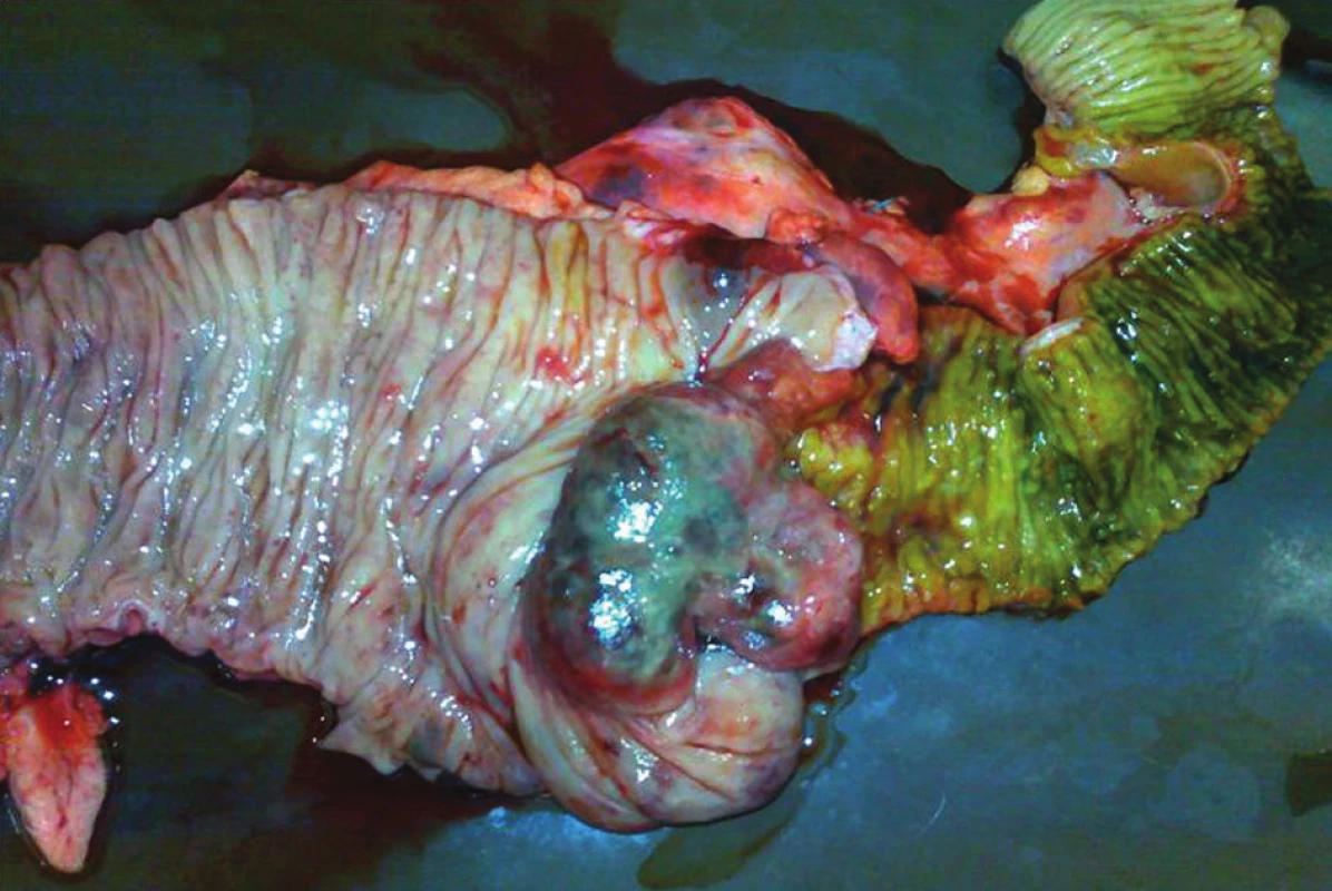 Resekovaná část ileocekálního přechodu s tumorem
Fig. 1: Resected part of the terminal ileum and caecum with tumor