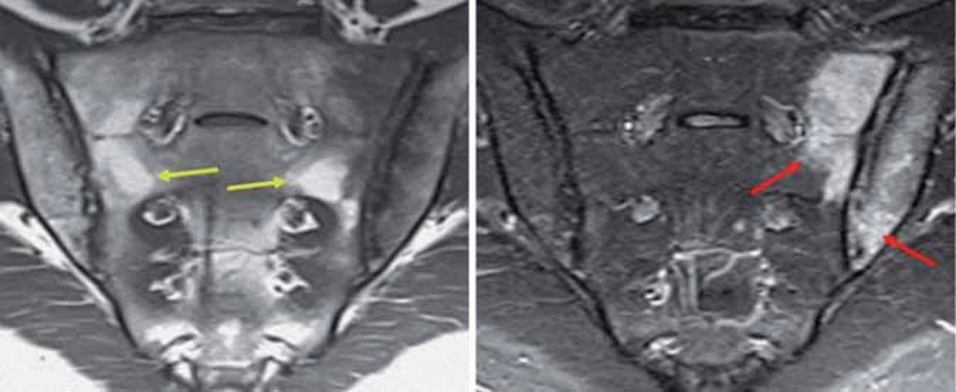 Edém kostní dřeně v oblasti SI skloubení dle MRI (STIR), tuková infiltrace (T1).