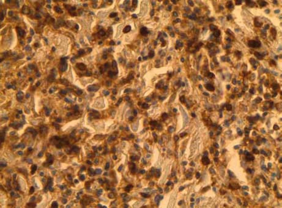 Leukocyte common antigen (LCA) pozitivní buňky infiltrující myokard.