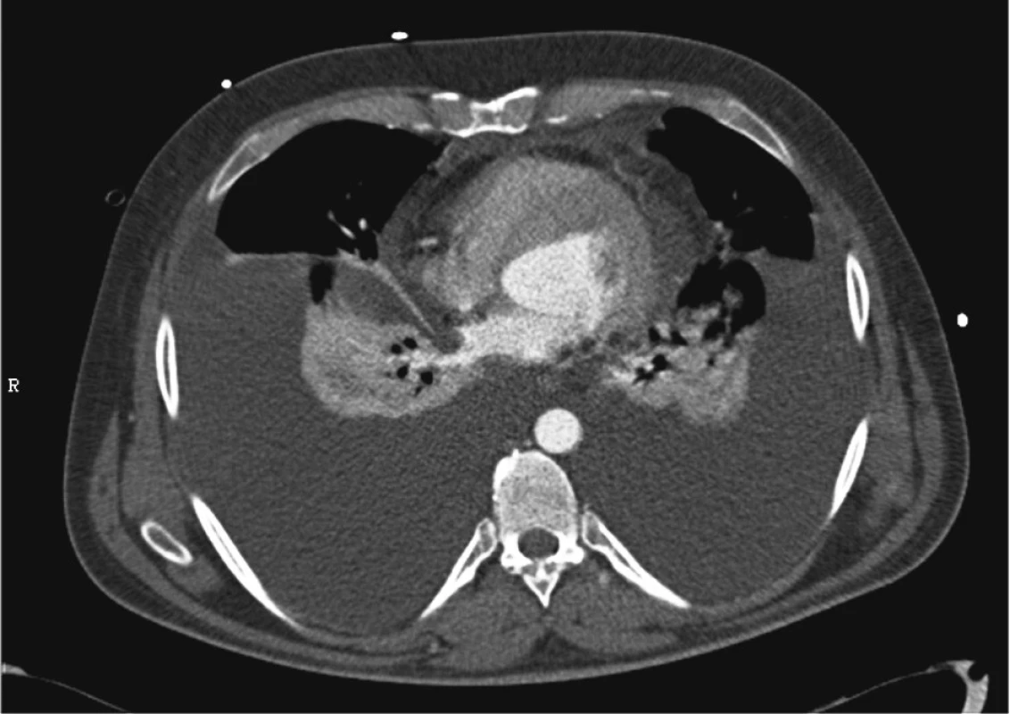 CT – oboustranný fluidotorax, prosáknutí mediastina
Fig. 3. CT scan – bilateral fluidothorax, mediastinal effusion
