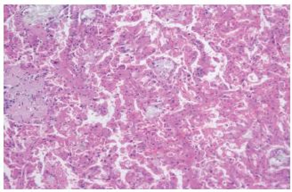 „Acquired cystic disease–associated“ RK. Nádory jsou obvykle kribriformní, avšak na tomto záběru je zachycen papilárně uspořádaný tumor s eozinofilními elementy s přítomností četných oxalátových krystalů.