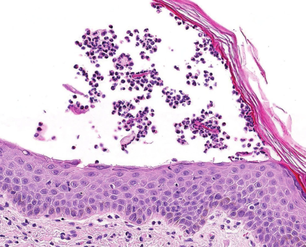 Detailní obraz bulózních změn při IgA pemfigu ukazující kout zobrazené buly s neutrofily.