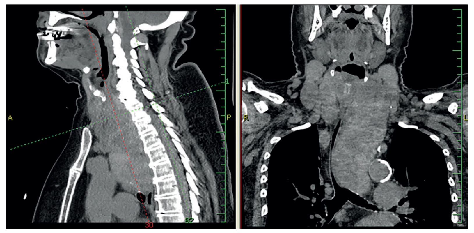 Retrosternální struma pod oblouk aorty až k bifurkaci trachey<br>
Fig. 1: Retrosternal goiter below the aortic arch, up to the tracheal bifurcation