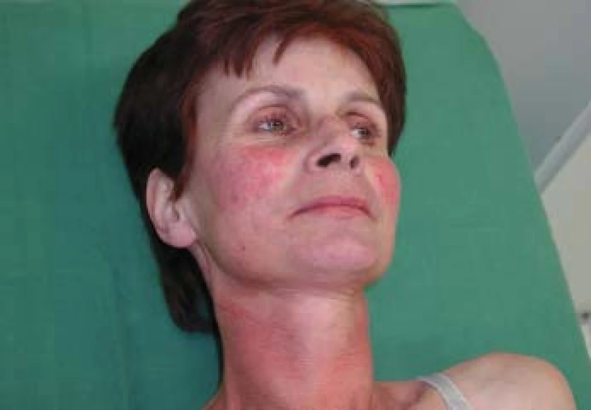Kožní změny při syndromu karcinoidu – teleangiektazie v obličeji.