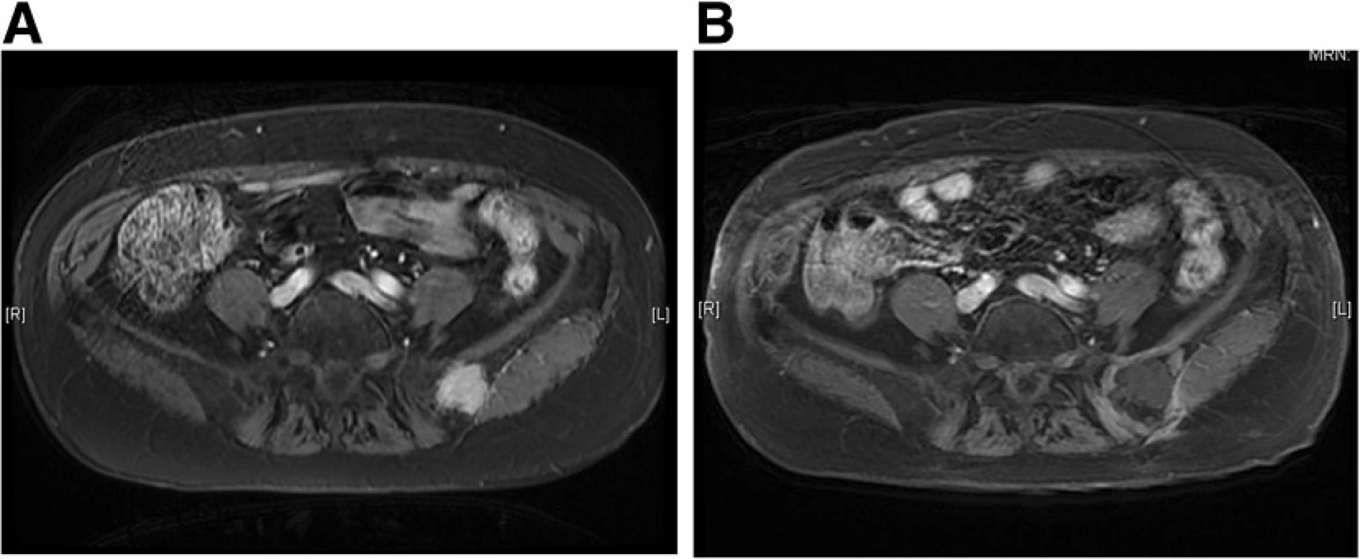 Gadolinium enhanced T1 - weighted MR image with fat suppression of an iliac metastasis from thyroid carcinoma (a) and 6 months after cryoablation (b). The effect of cryoablation is depicted as a low-signal intensity area with rim enhancement. The low-intensity area persisted during the 3 - year follow - up, a result consistent with no local recurrence