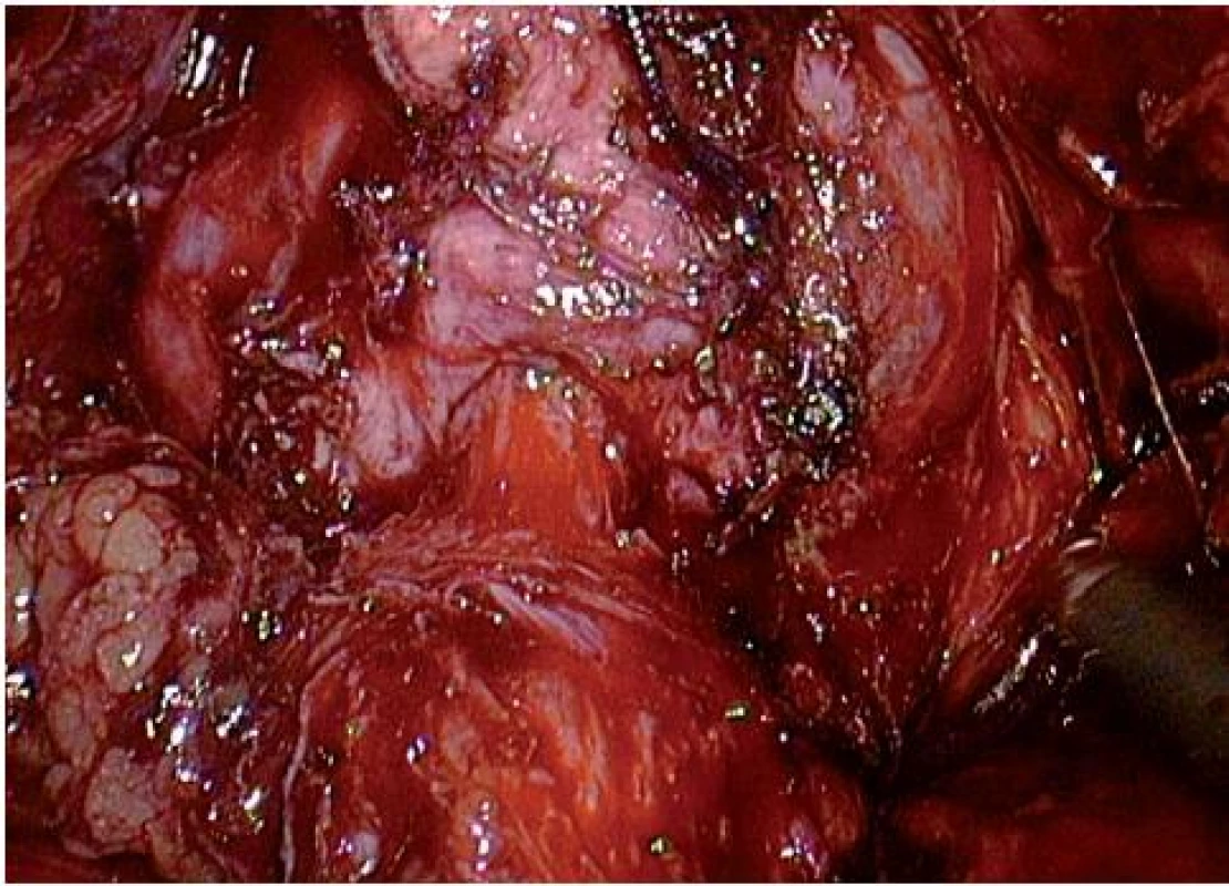 Hrdlo šetřící oddělení měchýře od prostaty
Fig. 5. Bladder neck sparing separation prostate from bladder