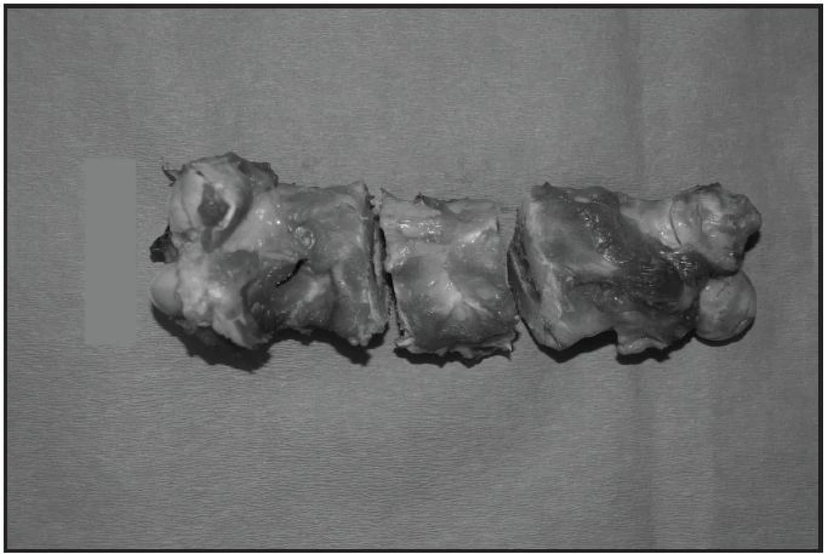 Vyjmutý femur s vyříznutím původního defektu s 3cm lemem do zdravé kosti