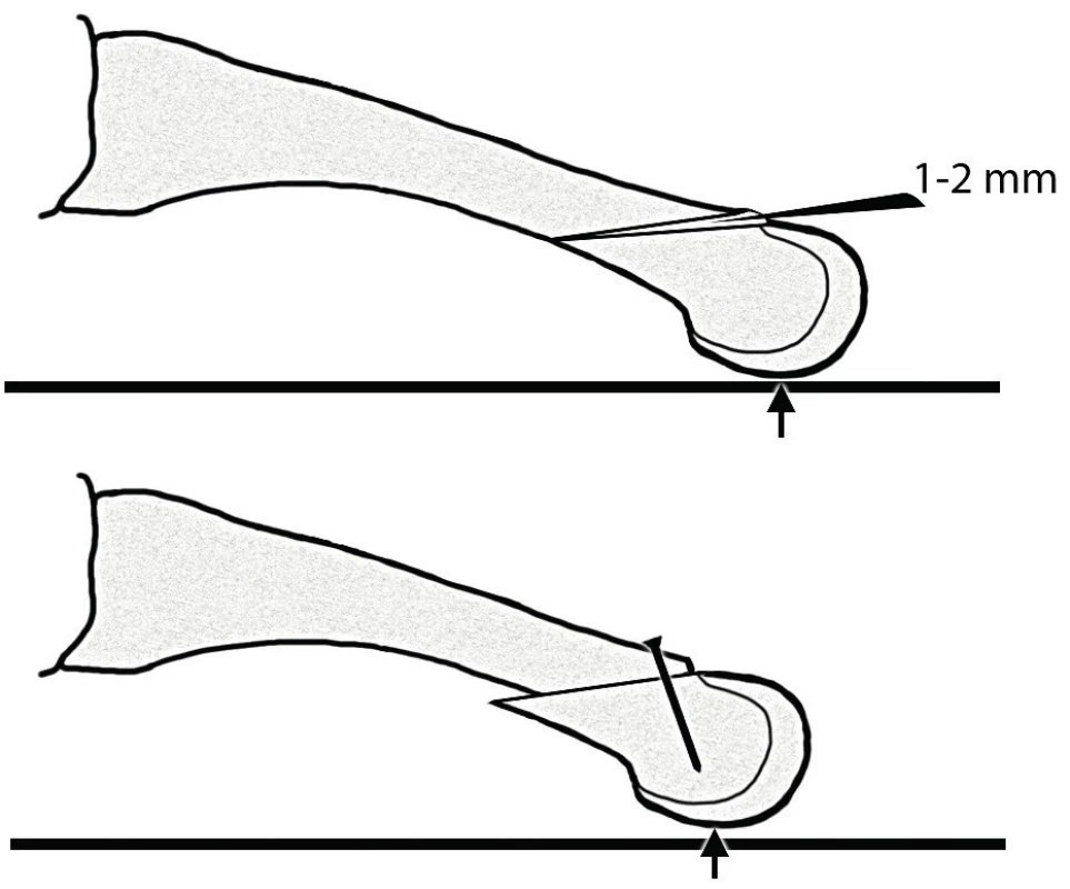 Boční pohled na druhý metatarz; modifikovaná operace dle Weila; vytětí klínku dorzálně na přechodu diafýzy; osteotomie je fixovaná šroubkem; černá šipka označuje místo zátěže hlavičky metatarzu.