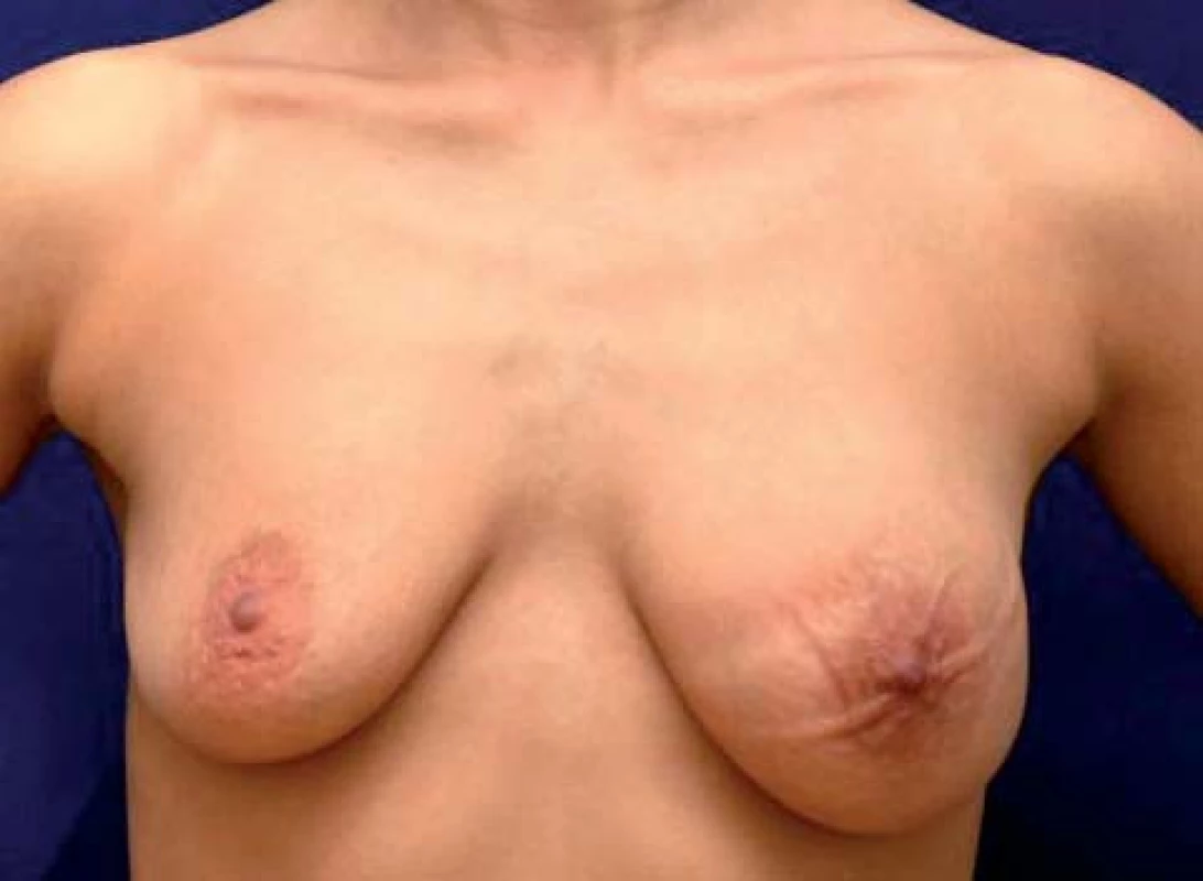 Edém a zvýraznění kožních žil levého prsu. Viditelná asymetrie, výraznější otlaky od spodního prádla, náznak pomerančové kůže; podkladem je multicentrický, téměř difuzní levostranný karcinom.