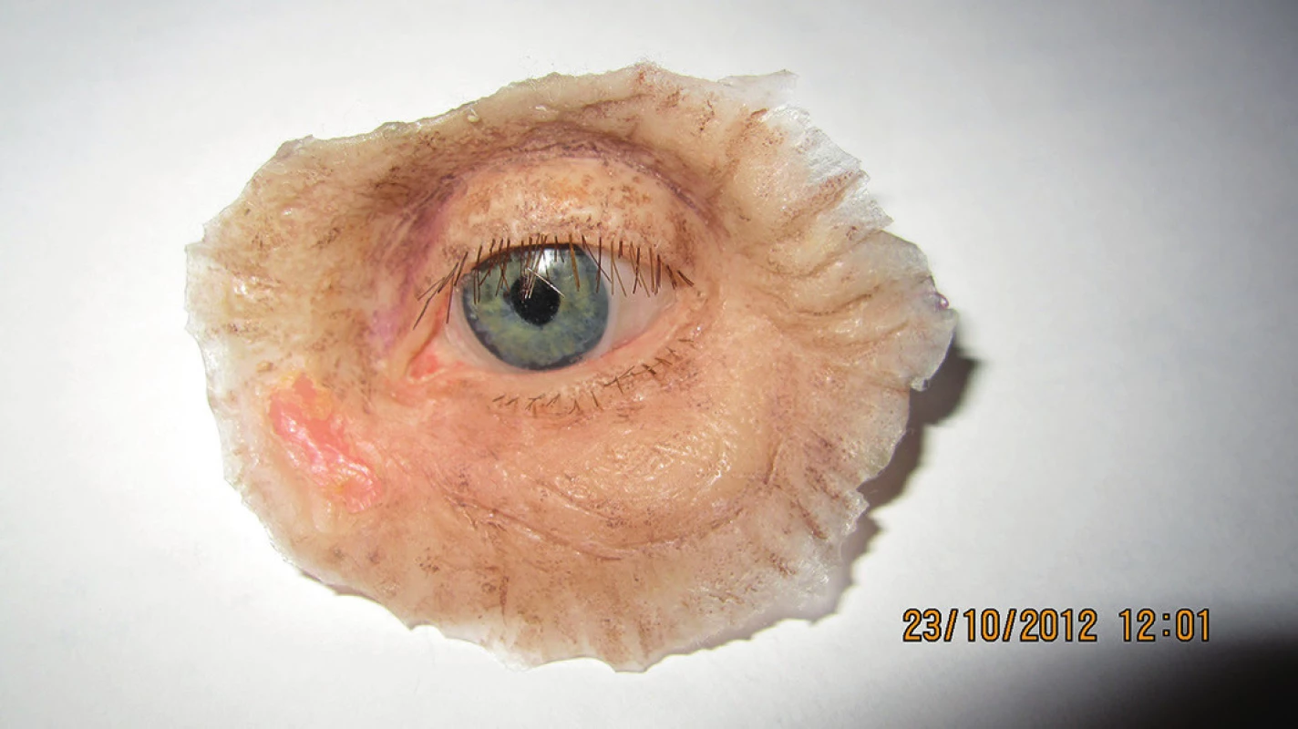 Individuálne zhotovená epitéza ľavej očnice pacientky