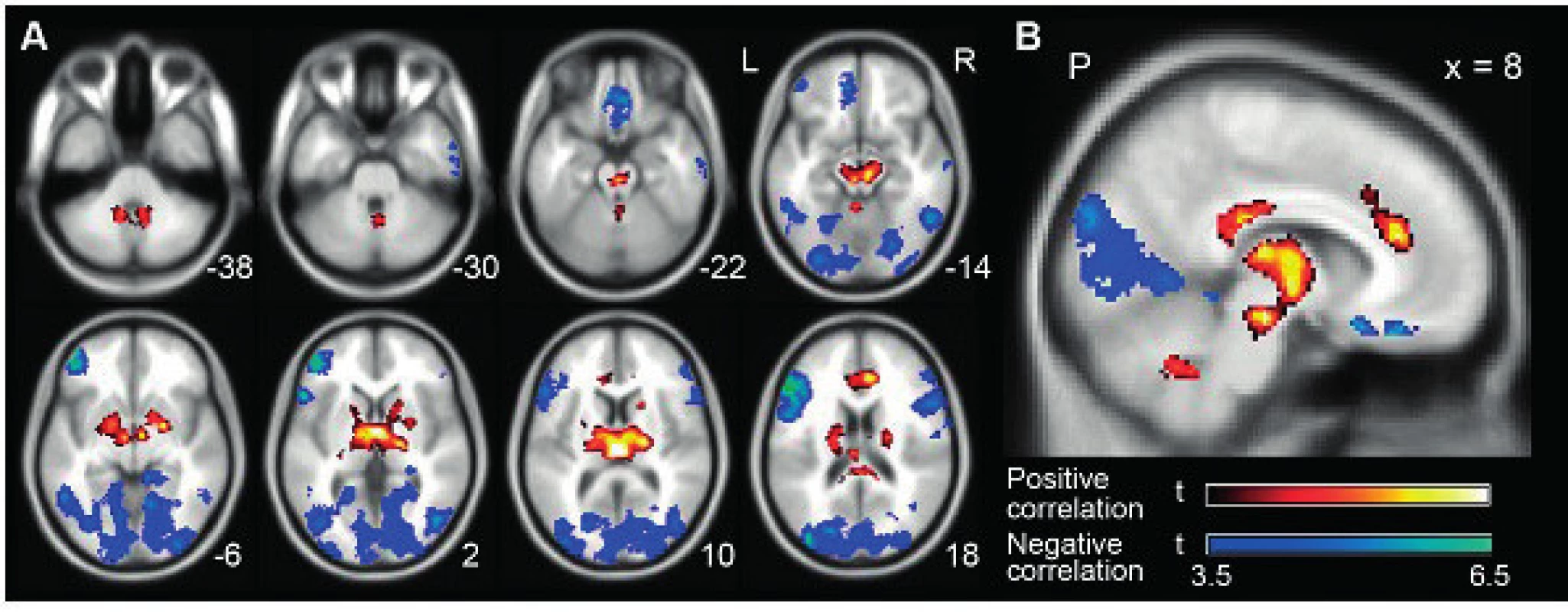 Skupina analýz korelující výskyt alfa aktivity a BOLD signálu v fMRI. Pozitivní korelace je červená a negativní korelace modrá barva (Omata K., 2013).