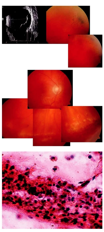 Schwartzův syndrom projevující se jako vitritida u 53letého muže. A) Ultrazvukové vyšetření potvrdilo amoci na pravém oku. V periferii sítnice levého oka patrné degenerativní změny. B) Nález na pravém oku po operaci amoce s laserovou baráží periferních vitreoretinálních degenerací. C) Histopatologické vyšetření prokázalo fragment vitreoretinální proliferace, v jehož okolí jsou i jednotlivé pigmentofágy