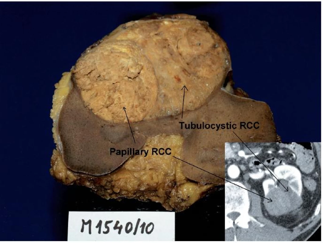 Muž 68 let, tumor levé ledviny T1bN0M0, histologicky se jednalo o tubulocystický renální karcinom s jasně odděleným ložiskem papilárního renálního karcinomu, což bylo možné zpětně identifikovat na CT (vpravo dole). 
Fig. 2. Sixty eight year old man, tumour of the left kidney T1bN0M0. Histologically, tubulocystic RCC with clearly visible locus of papillary RCC. The tumour could be retrospectively identified on CT as well. 
