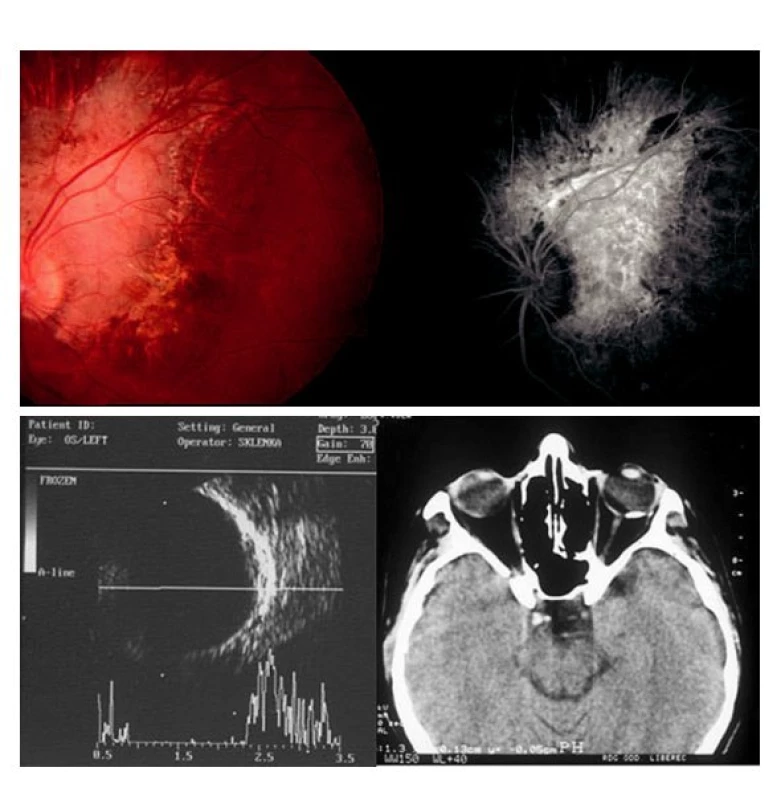 Choroidální osteom manifestující se jako infekční juxtapapilární chorioretinitida (toxoplazma) u 28leté ženy. A) Žlutooranžová léze v blízkosti papily optického nervu vykazuje hyperfluorescenci při fluorescenční angiografii. B) Ultrasonografie bulbu a CT vyšetření detekují kalcifikovanou tkáň
