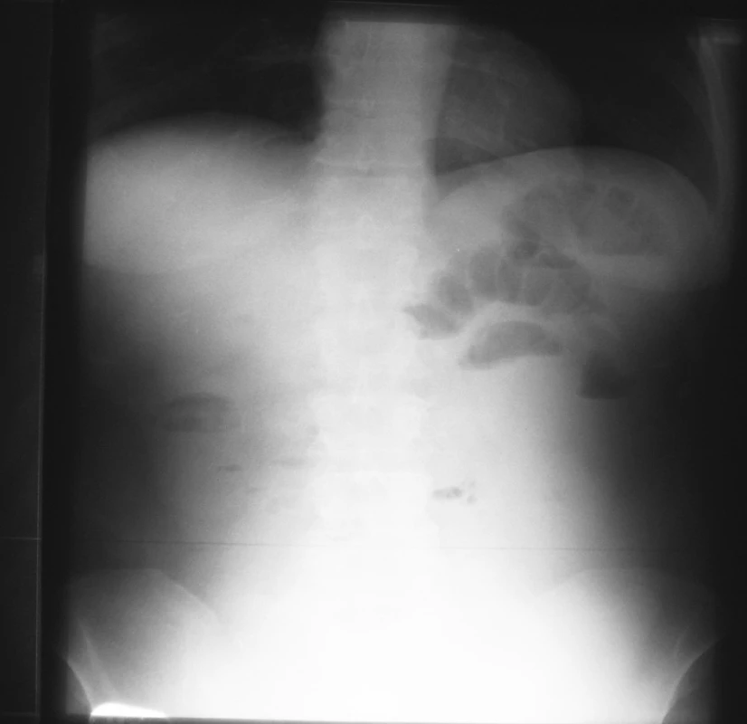 NSB postojačky – 17. 4. 2007 = kontrola na 3. deň hospitalizácie
Fig. 3. Upright native abdominal x-ray view – 17-04-2007 = a check-up on the 3rd hospitalization day