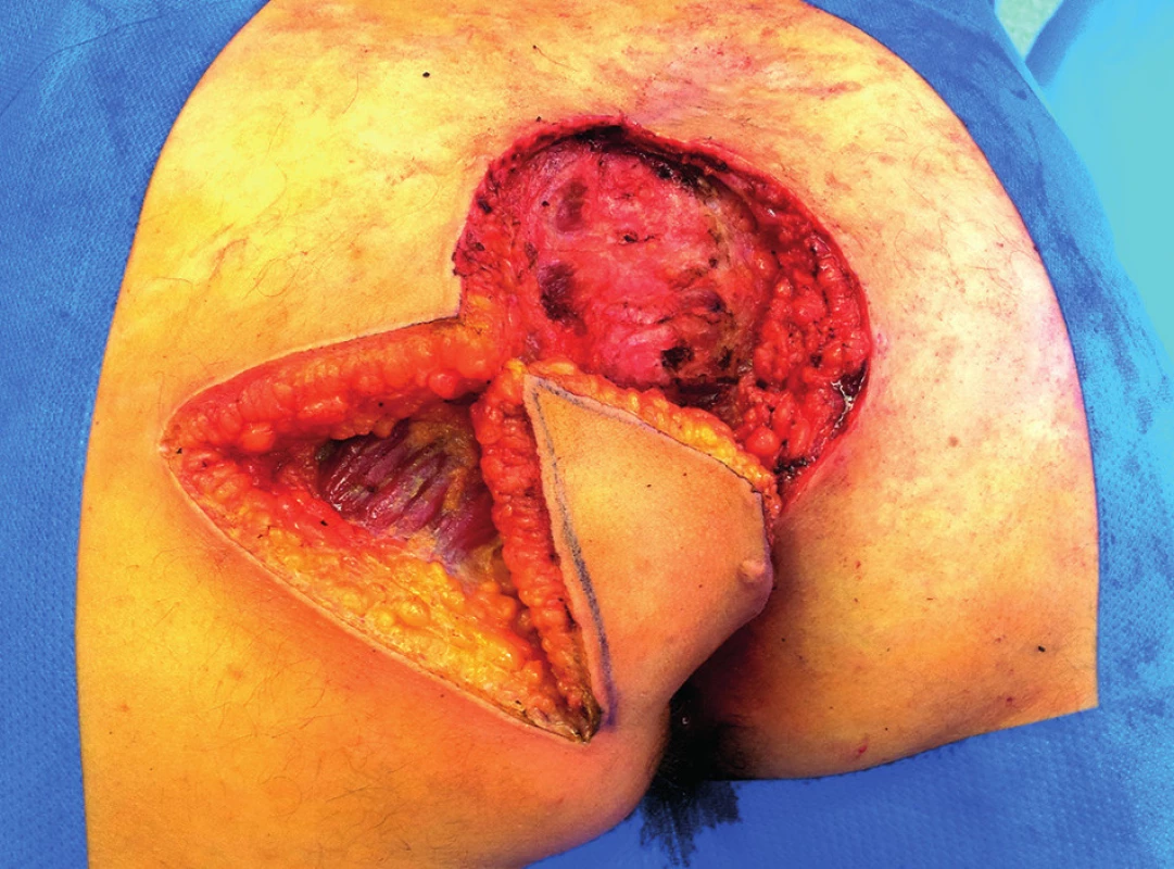 Stav po excizi a příprava laloku
Fig. 4: Finding after excision and preparation of the flap