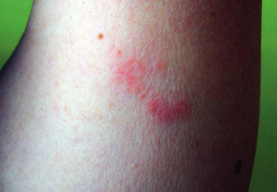 Po desiatich dňoch od popálenia medúzou. Erytémová makulopapulárna lézia (cca 9x4,5 cm) na extenzorovej strane paže so svrbením a s bolestivosťou. 1,5x.