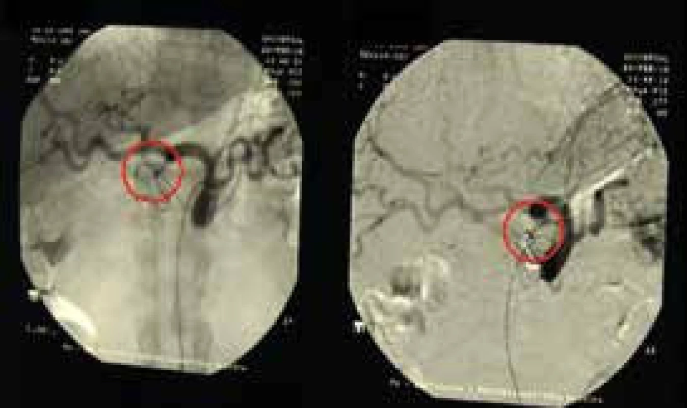 Selektívna angiografia truncus celiacus – embolizovaná pseudoaneuryzma a. gastroduodenalis – bez úniku kontrastnej látky