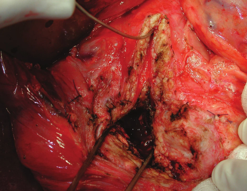 Freyova modifikace s lokální resekcí hlavy pankreatu s ponecháním zadní stěny hlavy a krčku pankreatu s longitudinálním vytětím přední části pankreatu ve tvaru V v průběhu pankreatického vývodu, připraveno k našití PJA side-to-side na exkludovanou jejunální kličku – operační foto