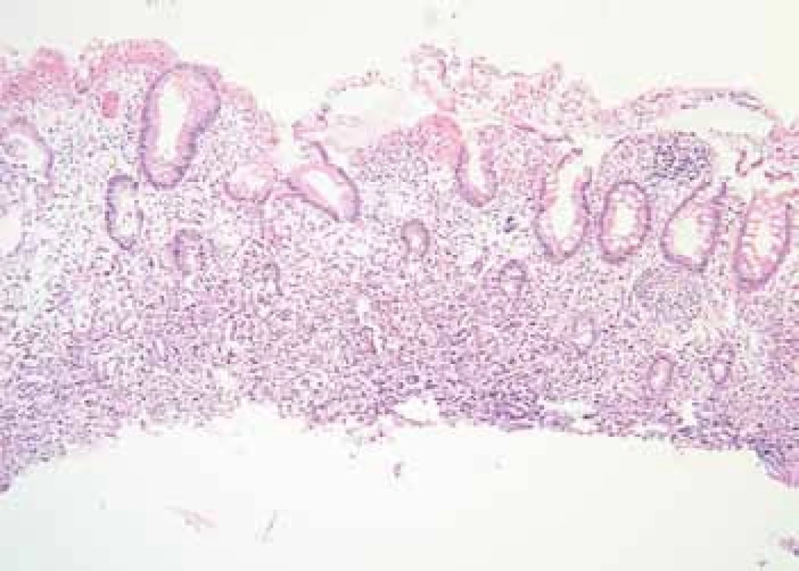 Histologické vyšetření barvení hematoxylin-eozin, zvětšeno 100×, prokazuje masivní infiltraci submukózy nádorovými buňkami tvaru pečetního prstenu.