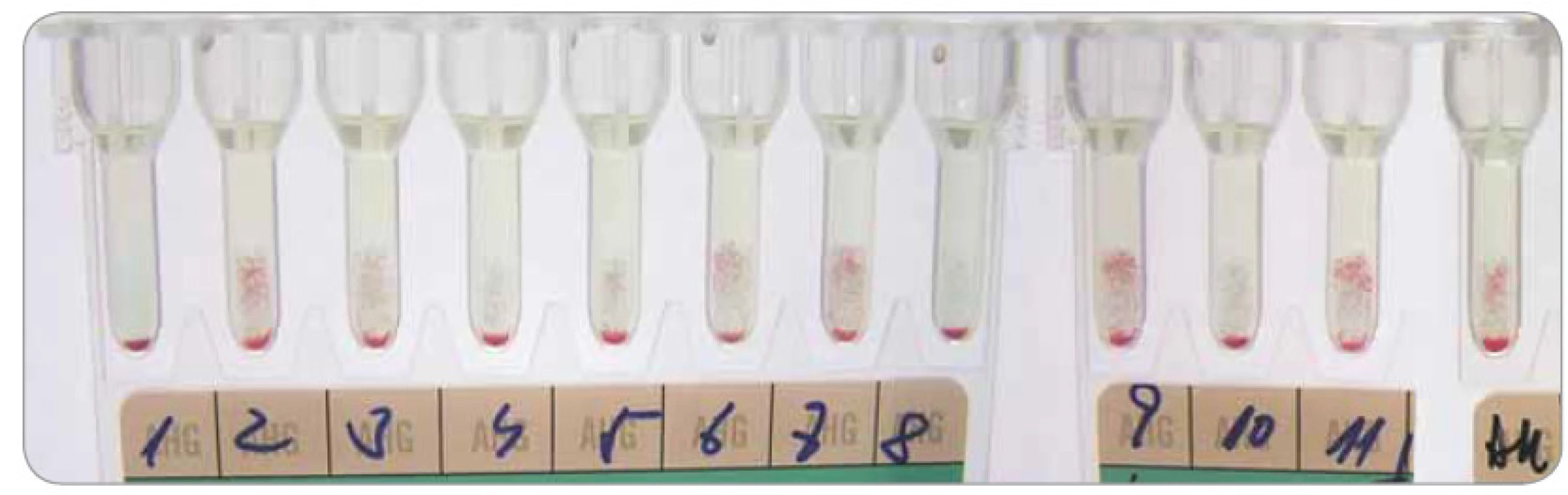 Identifikace erytrocytových protilátek na gelové kartě DG Gel (Grifols) – nediagnostický nález příčinou daratumumabu interferujícího v LISS-NAT.