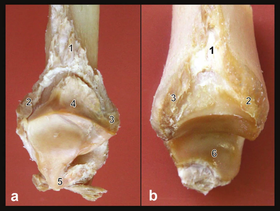 Anatomie vazů tibiofibulární syndesmózy
Preparát pravého hlezna; a – mediální plocha distální fibuly, b – laterální plocha distální tibie. 1 – lig. tibiofibulare interosseum, 2 – lig. tibiofibulare ant., 3 – lig. tibiofibulare post., 4 – plica synovialis tibiofibularis, 5 – společný začátek tří fibulárních vazů, 6 – kloubní plocha mediálního kotníku