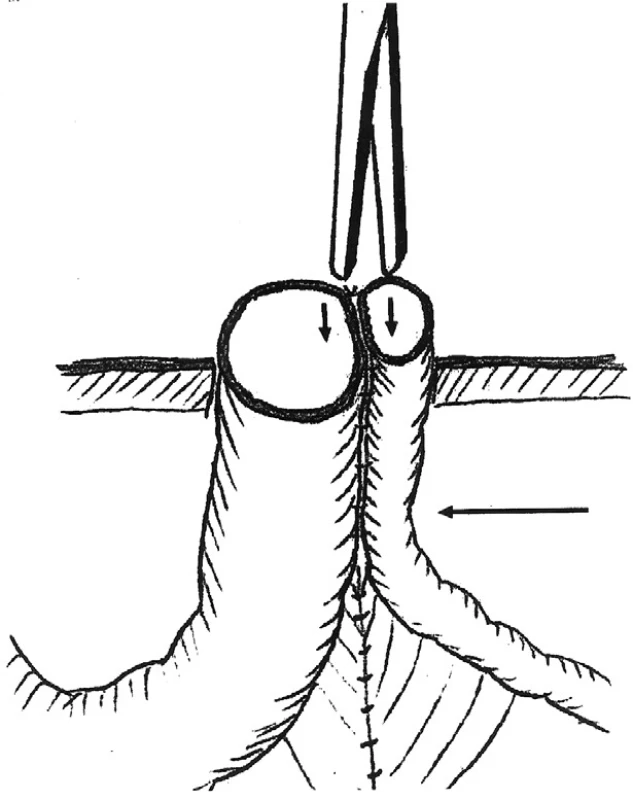 Schéma Grossovej metodiky s naznačeným uložením klemu, ktorý má urobiť tlakovú nekrózu
Fig. 2. The Gross method with indicated placement of a clam, expected to cause pressure necrosis