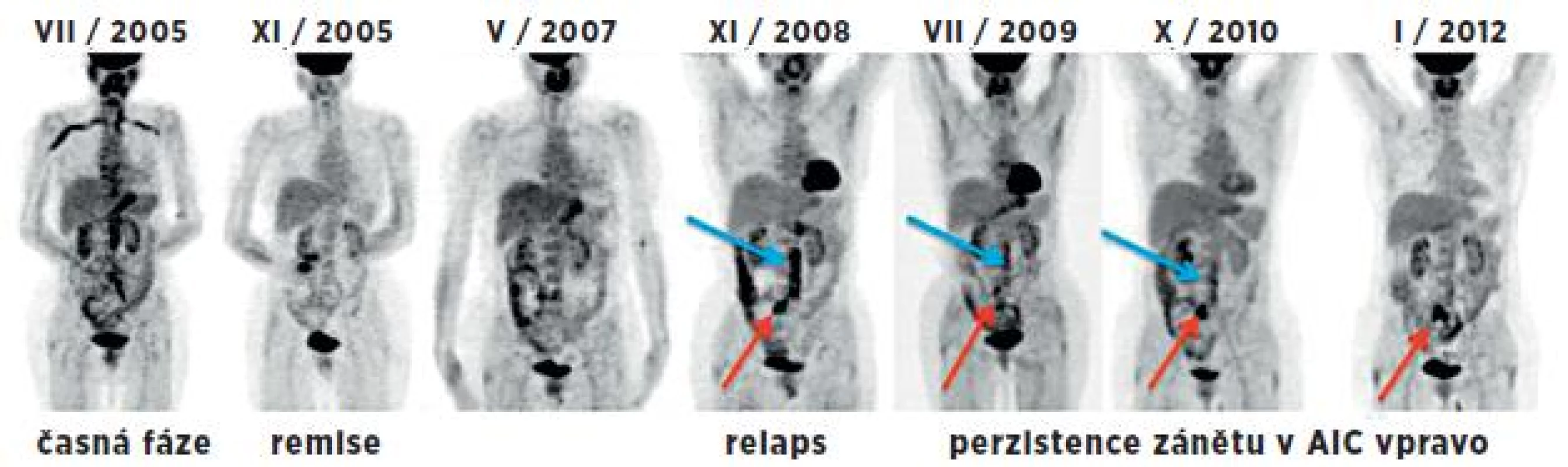 Souhrnný obraz 7 PET studií (MIP projekce) u 53leté pacientky v průběhu 6,5 let. Vlevo iniciální sken v časné fázi provázené elevací FW a CRP. Další 2 studie byly hodnoceny jako fáze remise při terapii prednisonem a po jejím ukončení. Následující studie odpovídají relapsu nemoci (v břišní aortě – modrá šipka a a. iliaca comm. l. dx. – červená šipka) v korelaci s klinickým nálezem, i laboratorními parametry. Při imunosupresivní terapii přechodně pokles s následným vzestupem akumulace FDG v těchto tepnách. I přes kombinovanou imunosupresivní terapii (cyklosporin A, methotrexát, prednison) je na poslední studii patrná perzistující vysoká metabolická aktivita ve společné ilické tepně vpravo – nález pravděpodobně odpovídá chronické fázi onemocnění.