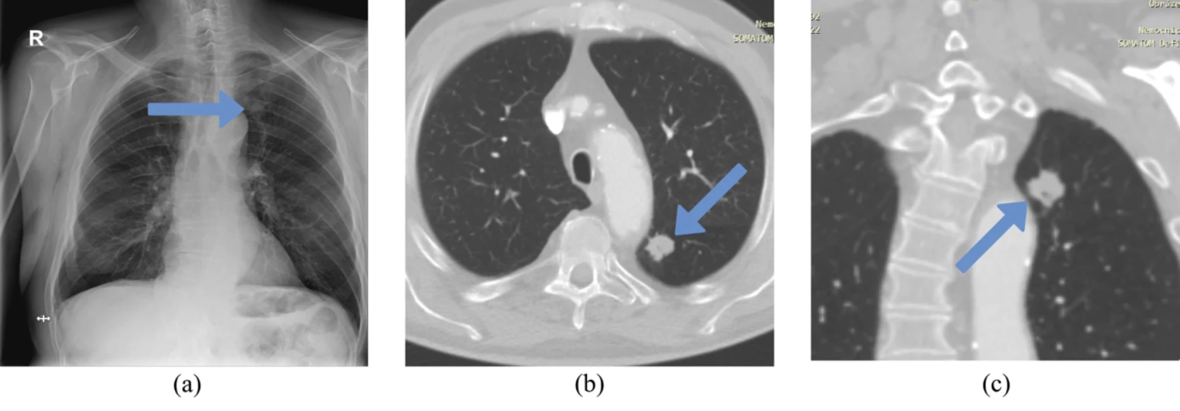 Vstupní rentgenový snímek hrudníku a kontrolní CT snímek s plicní lézí. 
