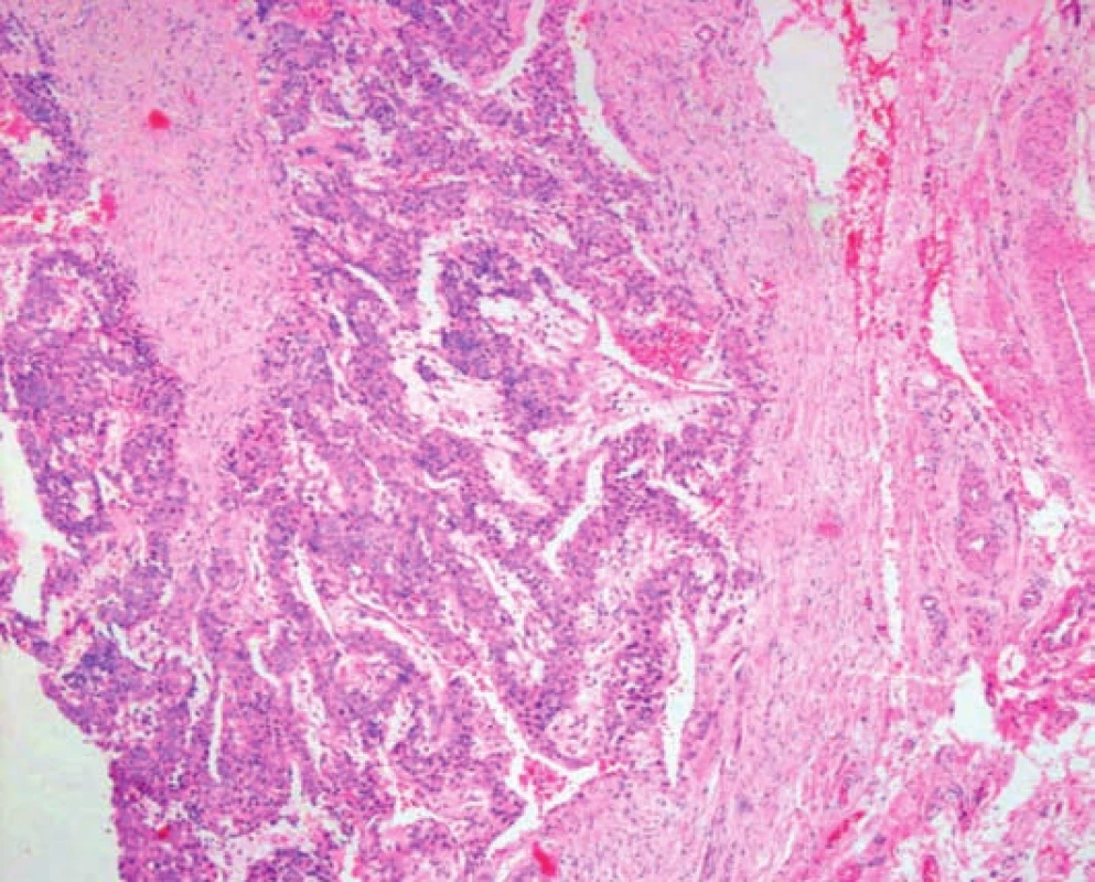 Histologický obraz glomus tumoru – barvení hematoxylineosin, zvětšení 40x