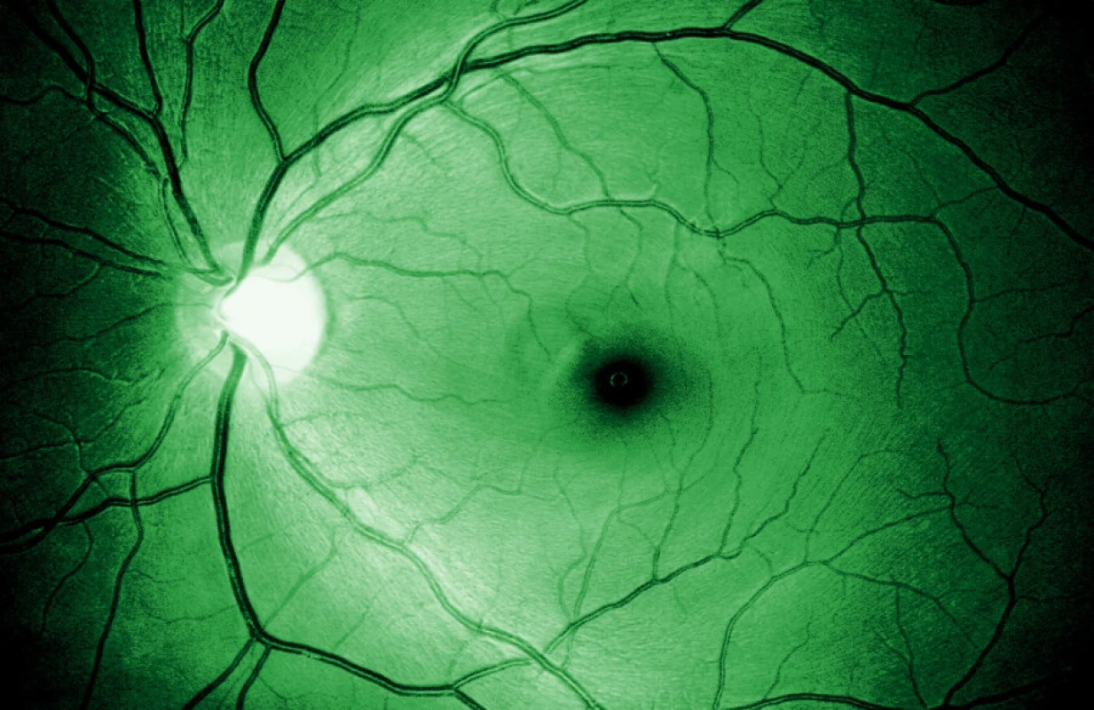 Vrstva nervových vláken zdravého oka