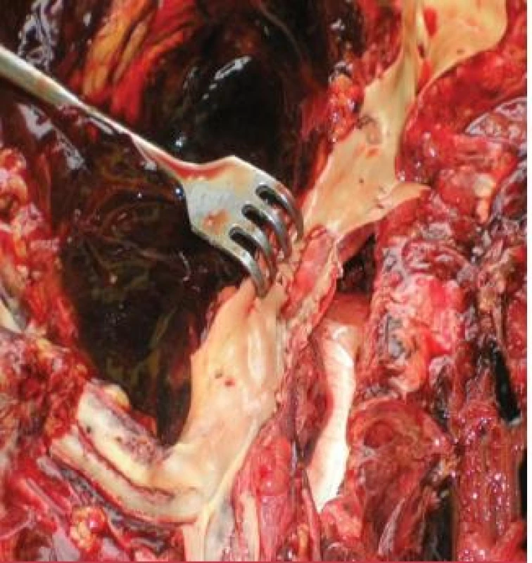 Ruptura aorty s všitou záplatou – foto z pitvy.