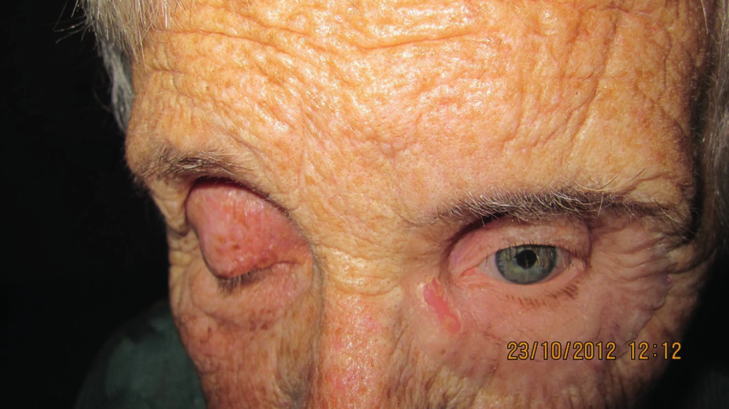 Detail oblasti očnice pri pohľade oka smerom nadol u pacientky s nasadenou ľavou epitézou