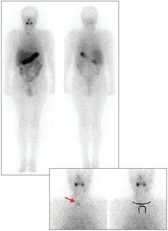 Celotělová a statická scintigrafie krku po téměř totální tyreoidektomii provedená 5 dní po aplikaci 5 000 MBq &lt;sup&gt;131&lt;/sup&gt;I
