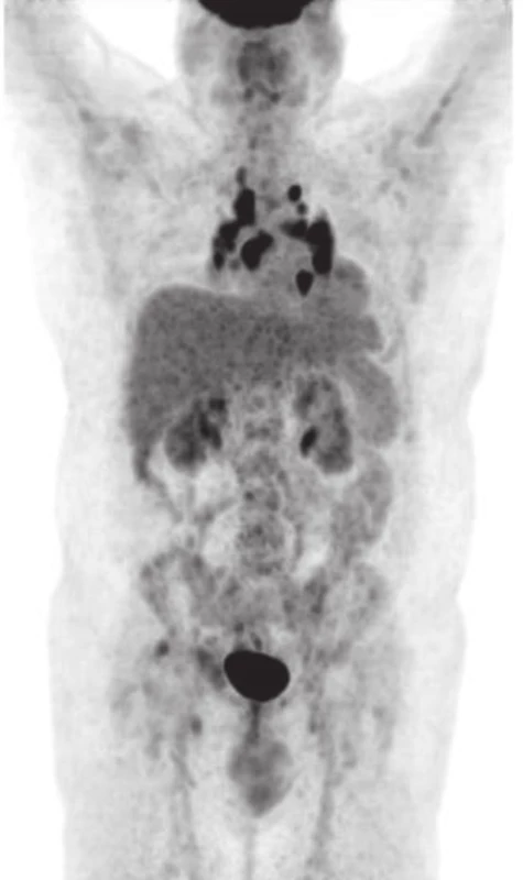 Pacient č.2, XI/2012 PET/LowDose CT (MIP).