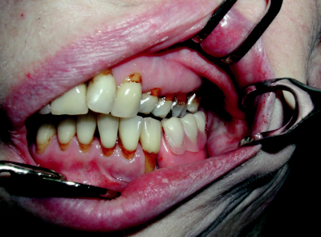 Pooperační náhrada in situ; zubní krčky pigmentované po aktinoterapii.