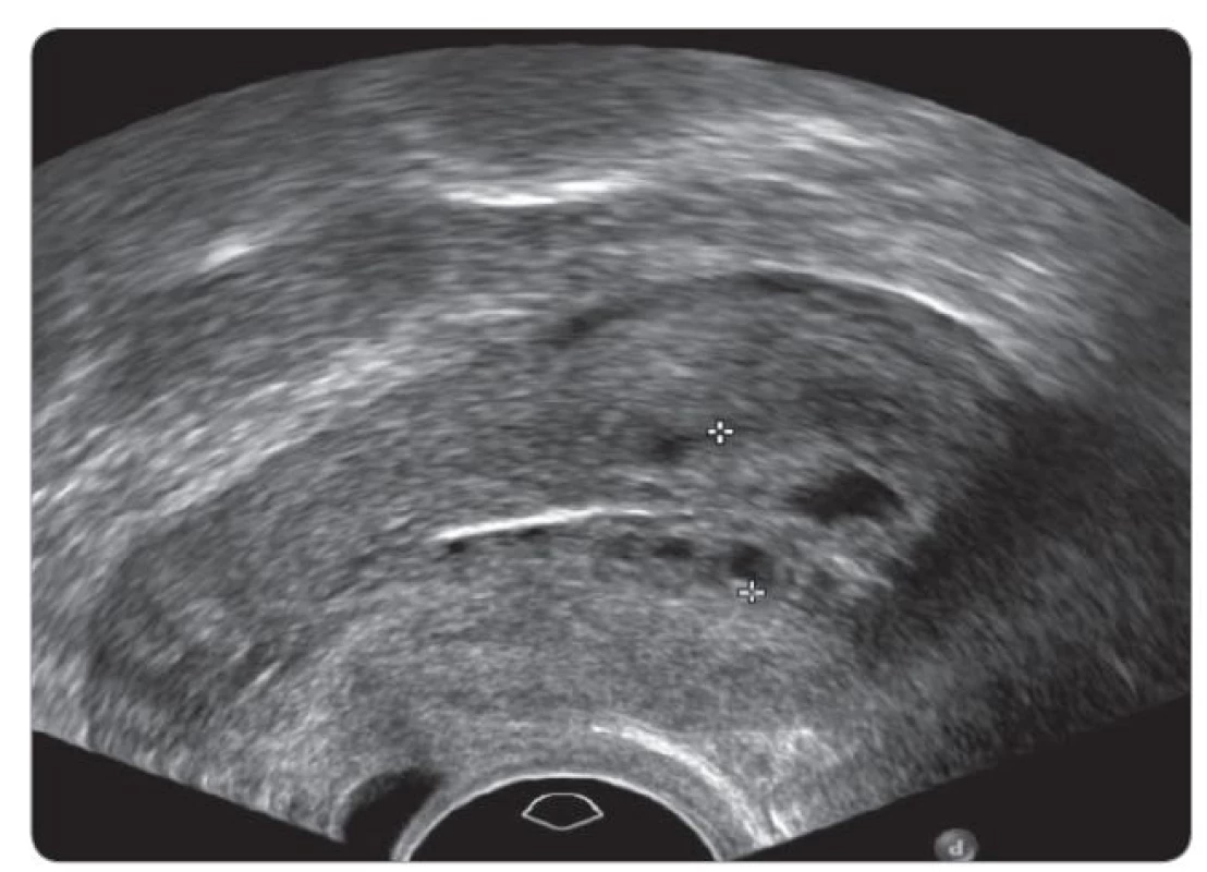 Subendometriální edém stromatu a cystická přeměna endometria imitující hyperplazii při transvaginálním sonografickém vyšetření (TVUS) u pacientky užívající tamoxifen.