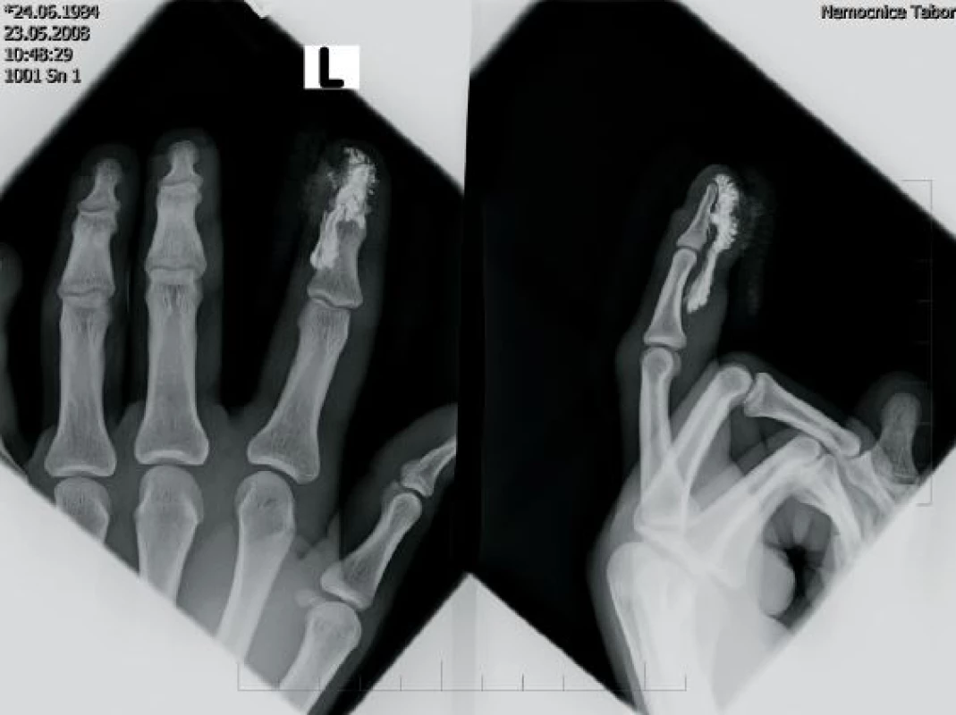Rentgenový snímek 2. prstu pravé ruky s rentgen kontrasní cizí látkou v měkkých tkáních