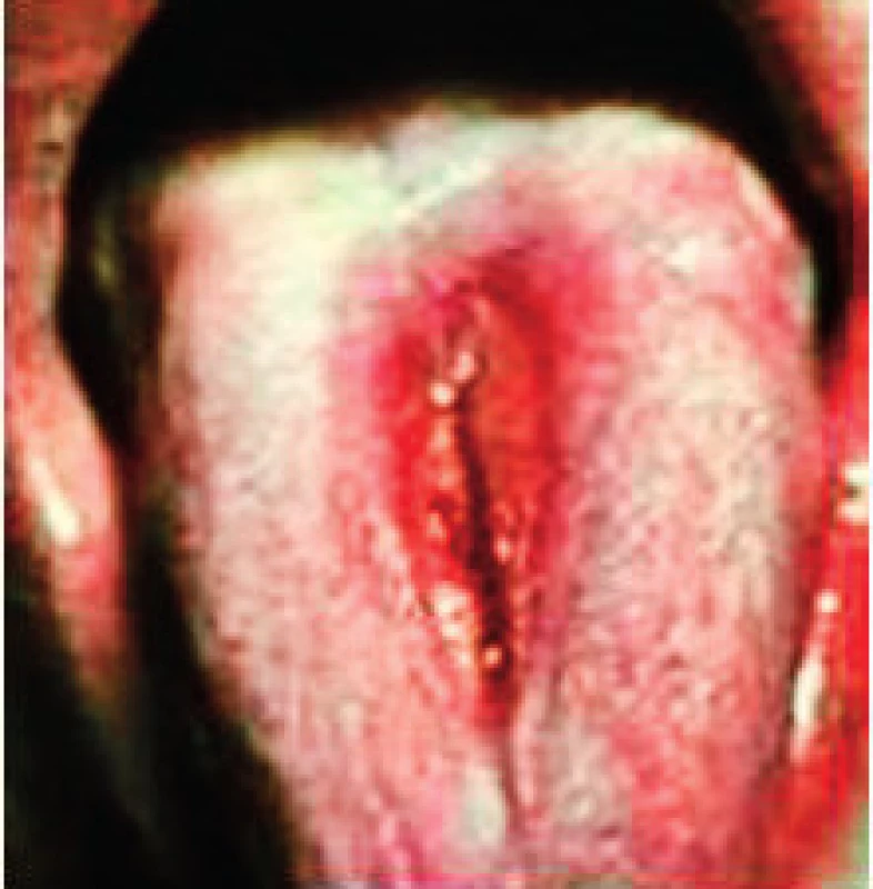 Patologicky zmnožený povlak jazyka. Jeho olupovanie začína na koreni jazyka a pripomína mapovitý jazyk
