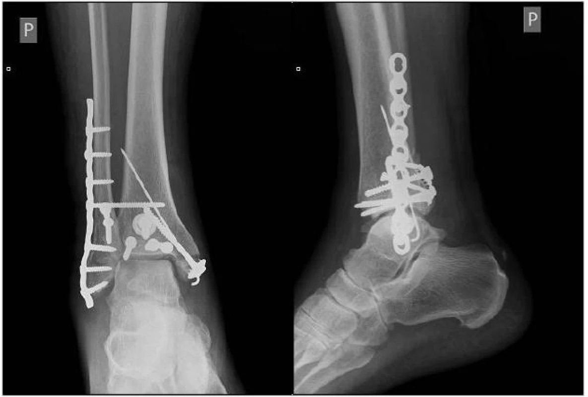 , 16: Pooperační RTG  snímky s ošetřením fibuly, mediálního malleolu, TF syndesmózy a Earlova fragmentu 